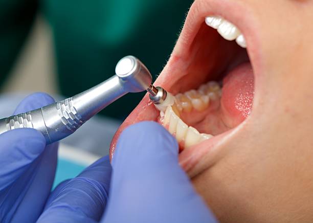 Best Wisdom Tooth Removal  in Sawyerwood, OH